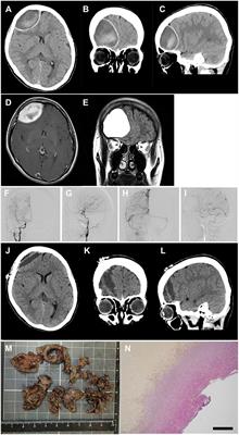 Non-traumatic Acute Epidural Hematoma in Multiple Sclerosis Treated With Fingolimod